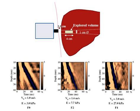 kpa results|Diagnosis of cirrhosis by transient elastography (FibroScan): a .